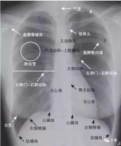 X线侧位胸片的诊断关键看这5个地方！帮你总结好了#医学影像# - 知乎