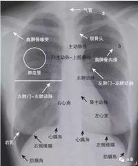 x线侧位胸片的诊断关键看这5个地方!帮你总结好了#医学影像