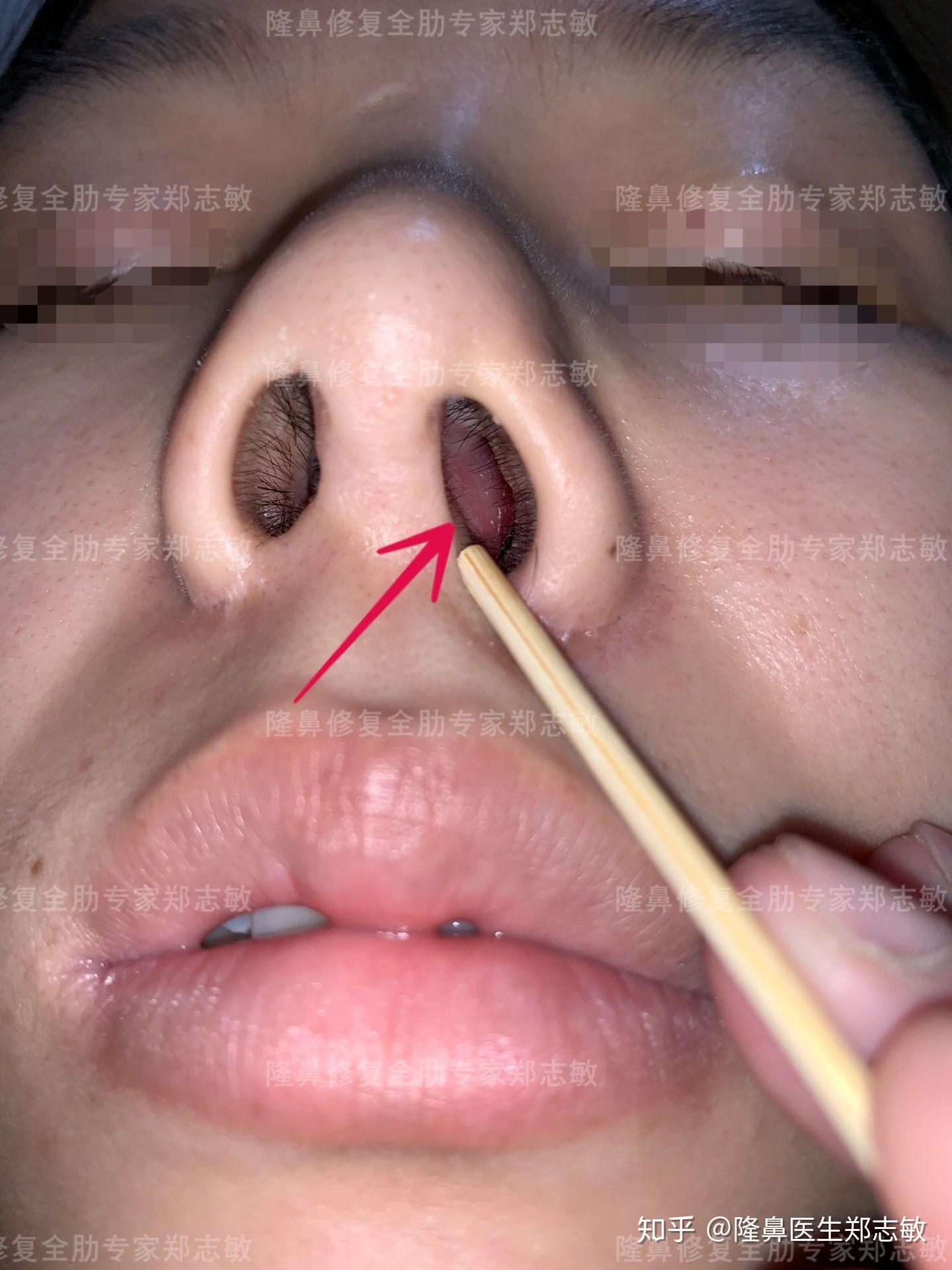 手术中发现整个中隔尾端明显左偏,之前的手术取了鼻中隔软骨来做抬高