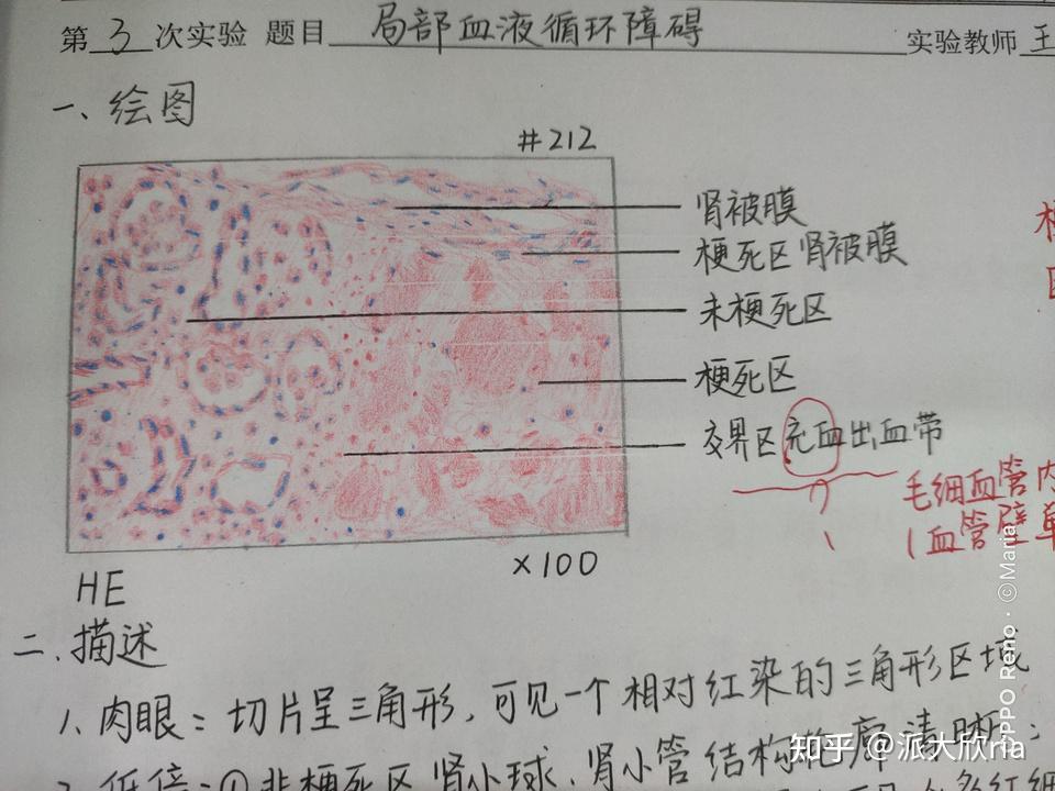 肾浊肿手绘实验报告图图片