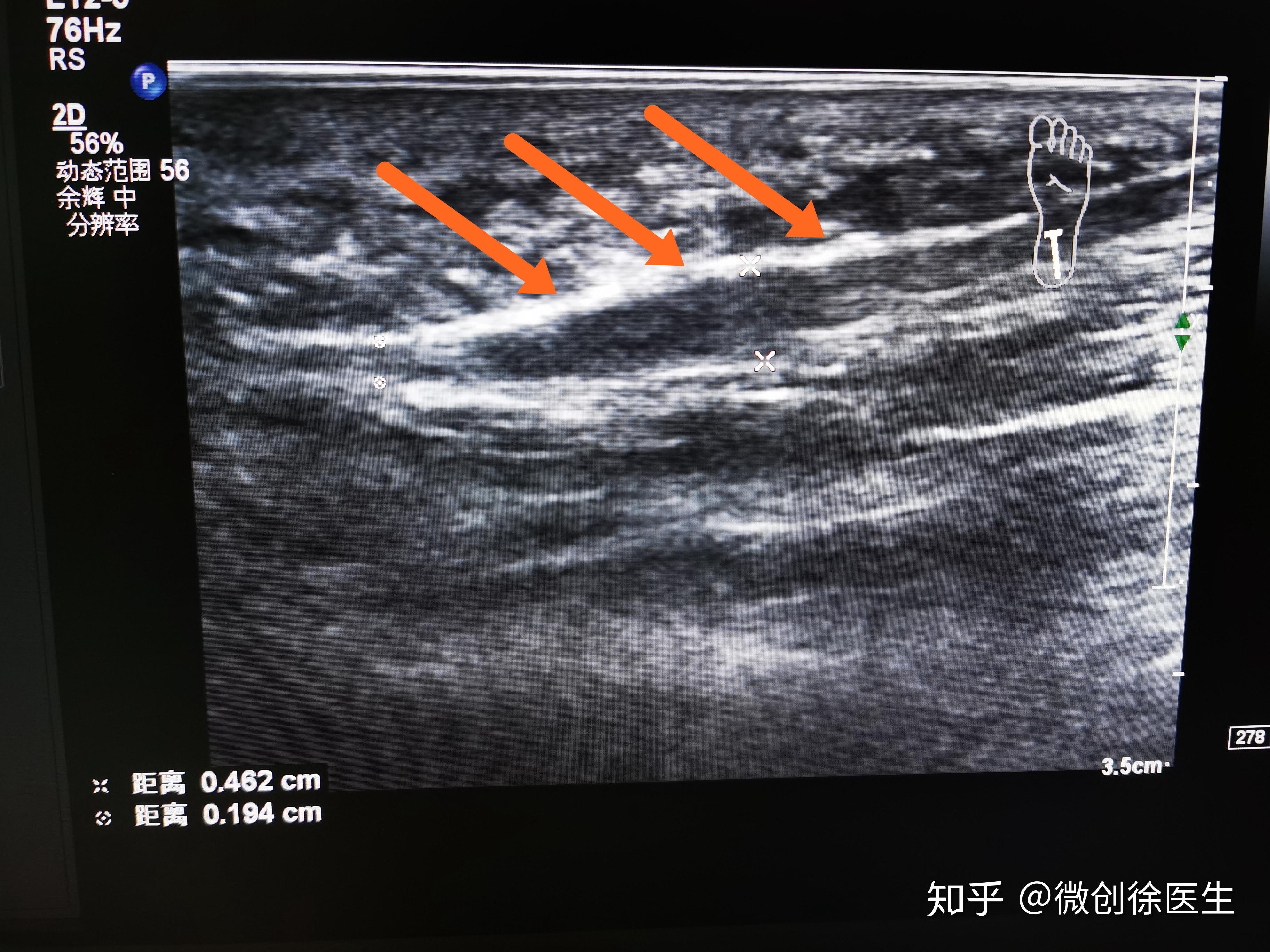 经朋友推荐来到浙江省荣军医院 超声介入科做了一个足底肌骨超声检查