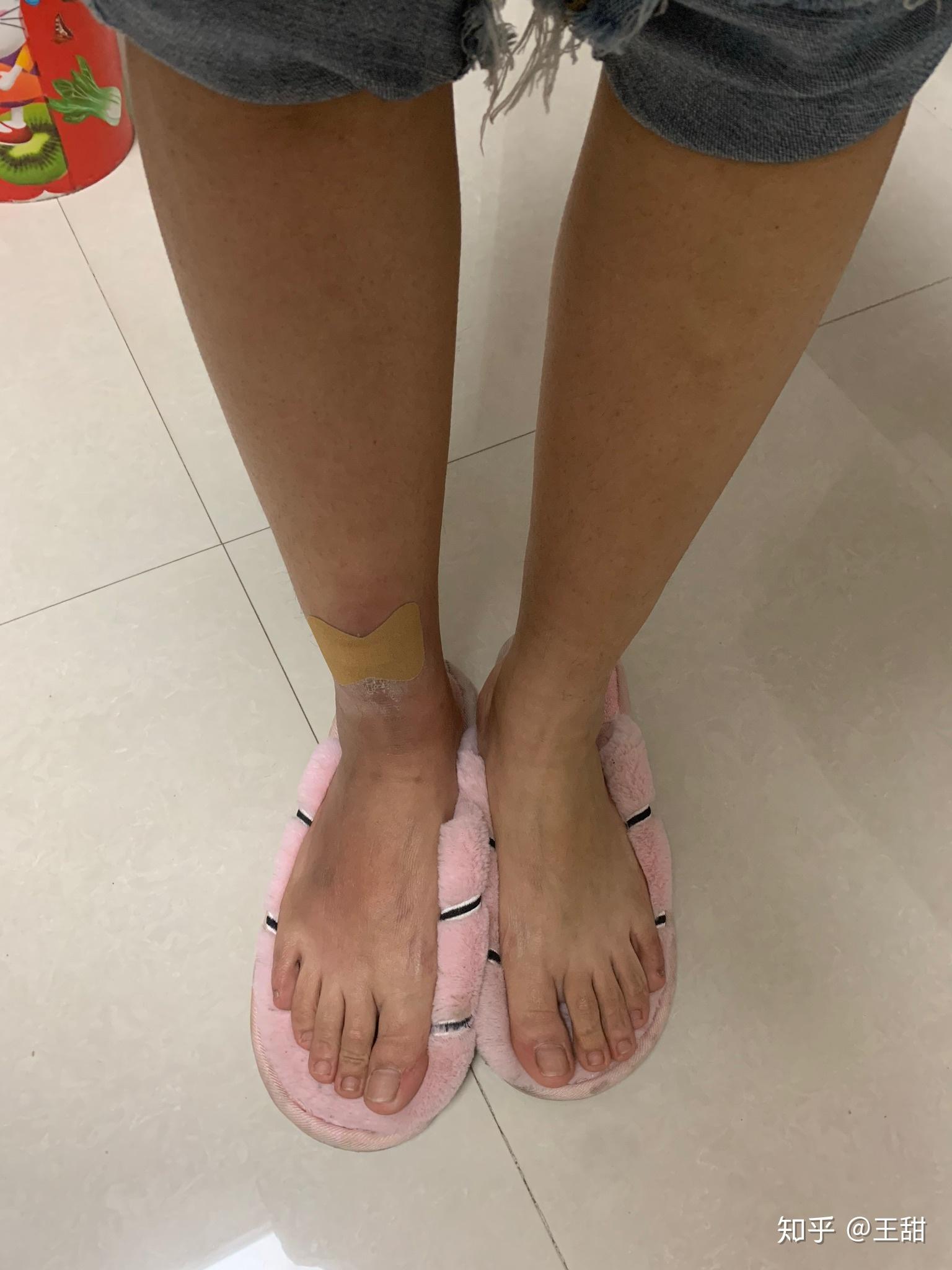 想说说关于脂膜炎伴血管炎的这么一个病! - 知乎