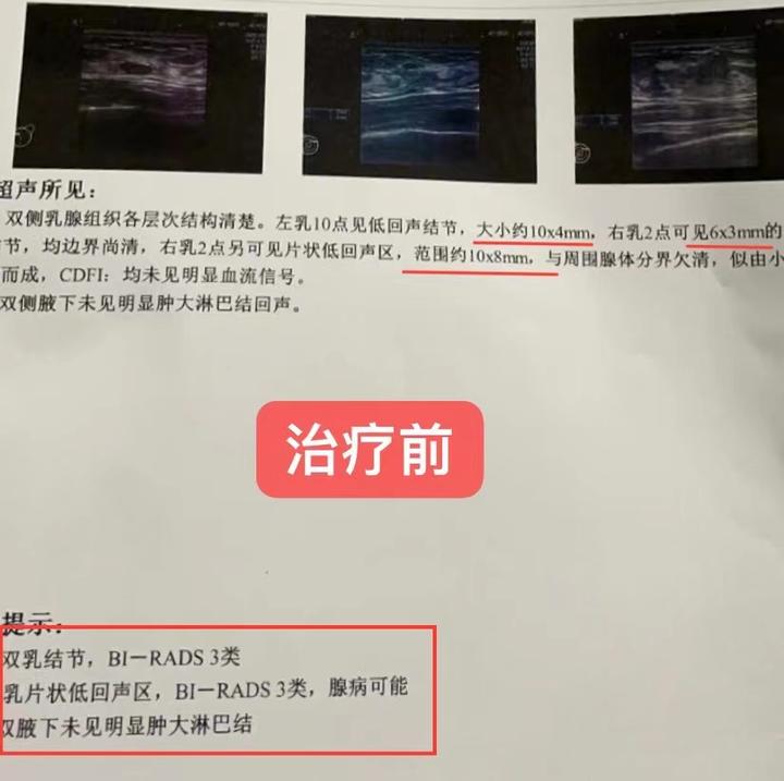 3类双乳结节的佟女士调理4个月终于降级了