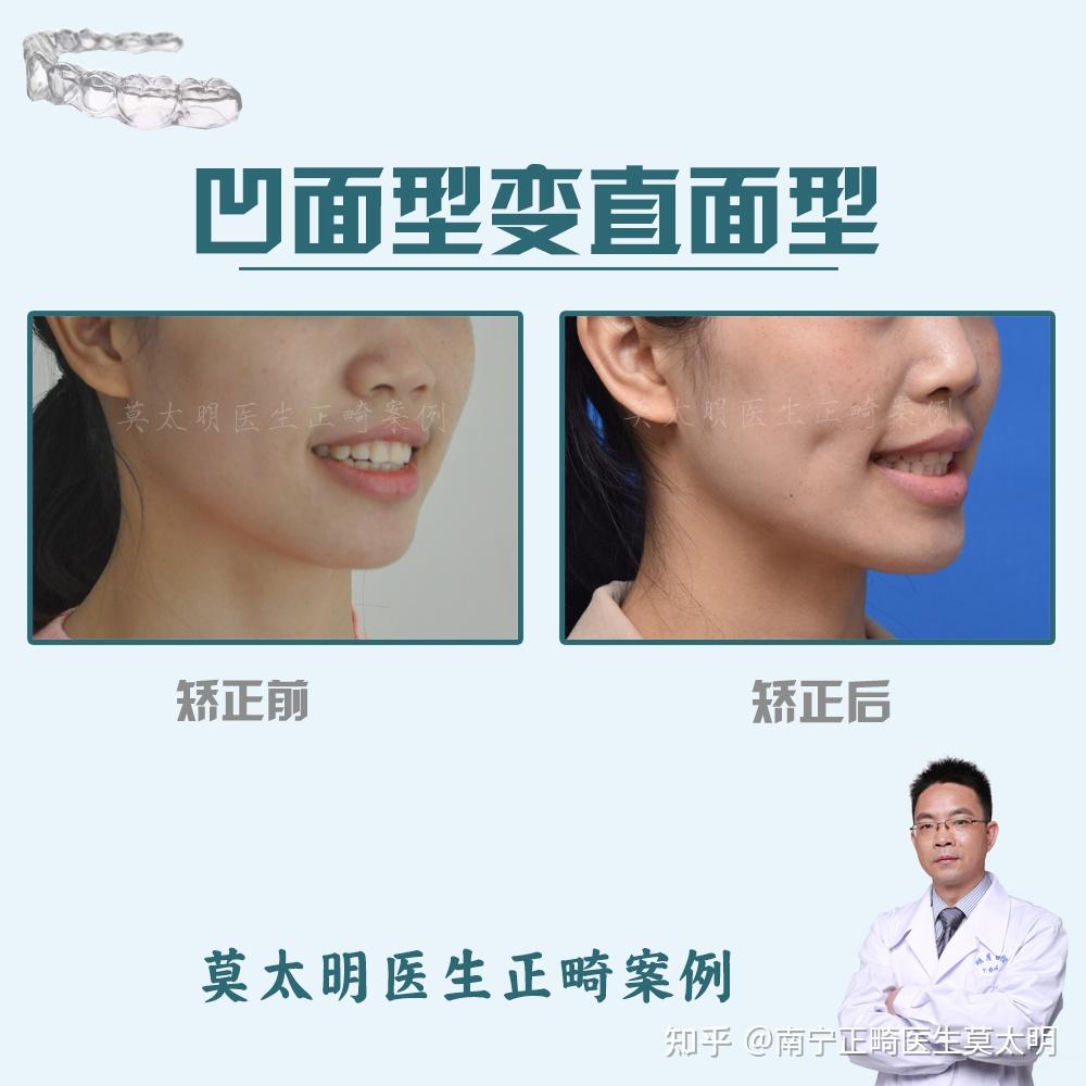 2,下后牙远中直立并压低,调整上颌中线,配合支抗钉内收压低上前牙.