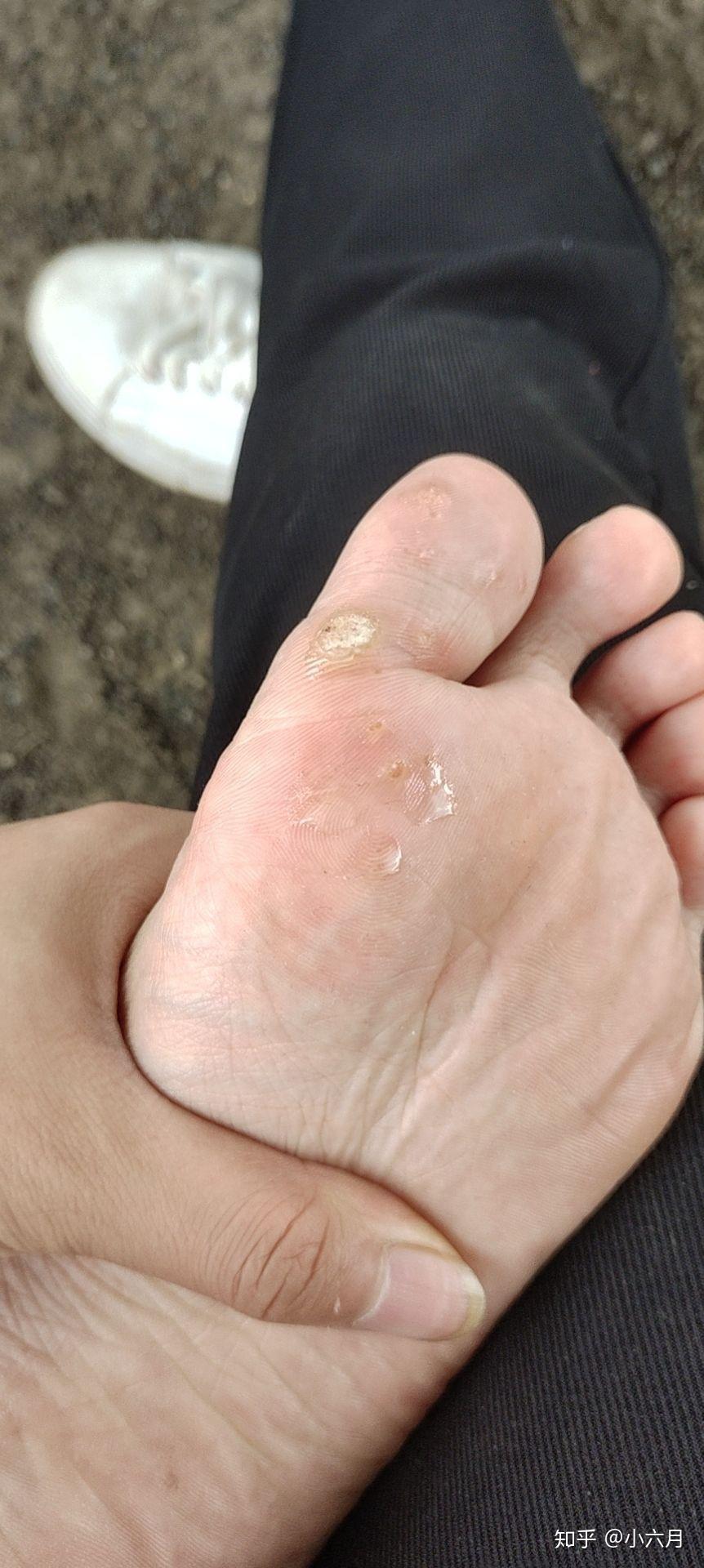 关于跖疣用蒜敷了十三天的结果带图