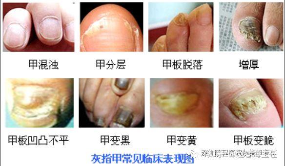 甲病变始于甲远端,侧缘或甲褶部,表现为甲颜色和形态异常.