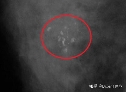 乳腺良恶性钙化有什么区别? - 知乎