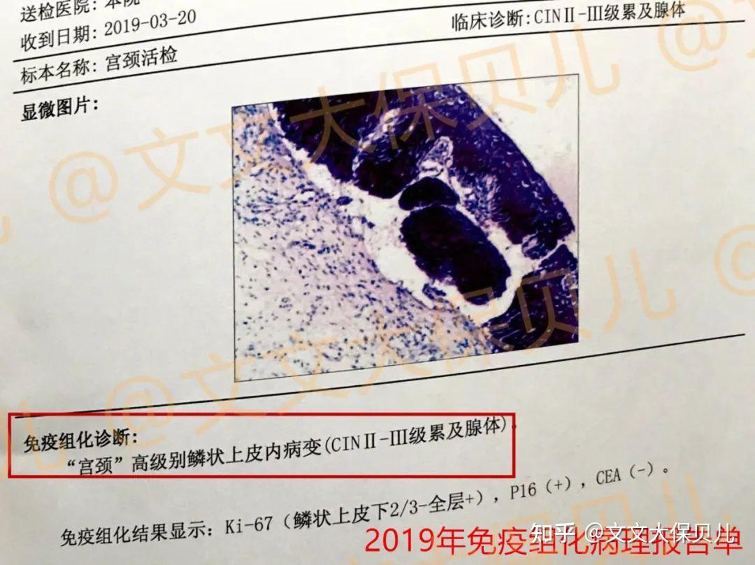 cin23级累及腺体宫颈癌前病变手术后该怎么买保险