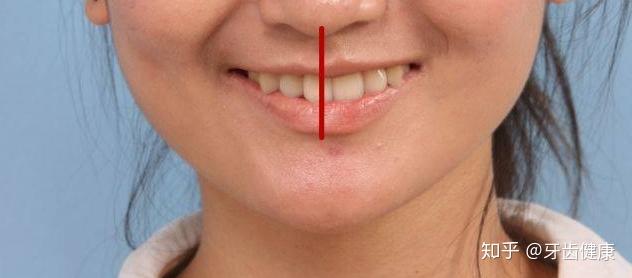 也有部分小伙伴在看牙时,听到牙医提到:"牙齿有点中线不齐",很多人对