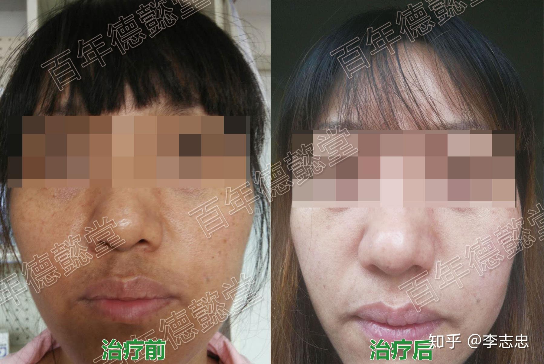 德懿堂治疗黑变病一则 - 知乎
