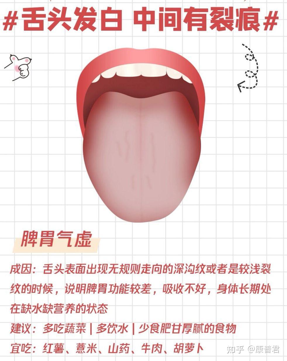 一张图让你简单看懂中医舌诊!