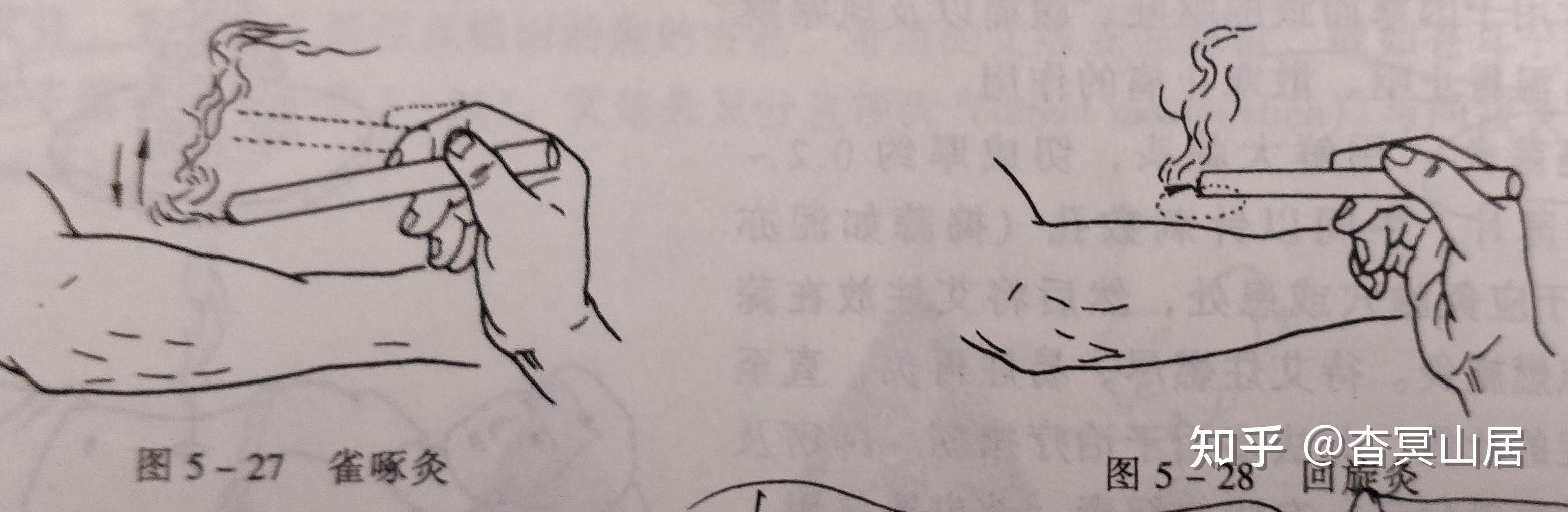 笔记摘要——针灸技术:毫针刺法、补泻原则与灸法概要 - 知乎