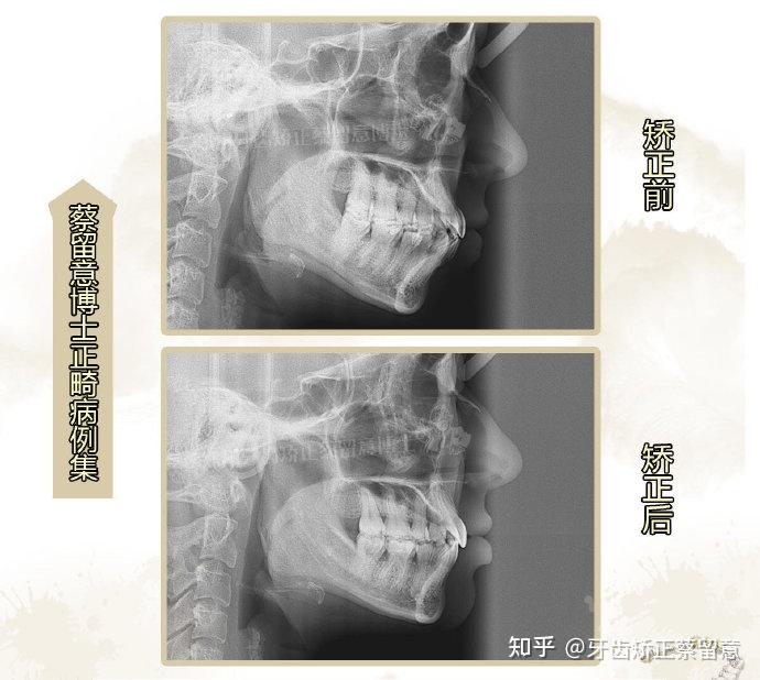 郑州隐形矫正骨性地包天偏颌多种症状集于一身舌侧矫正可有效解决
