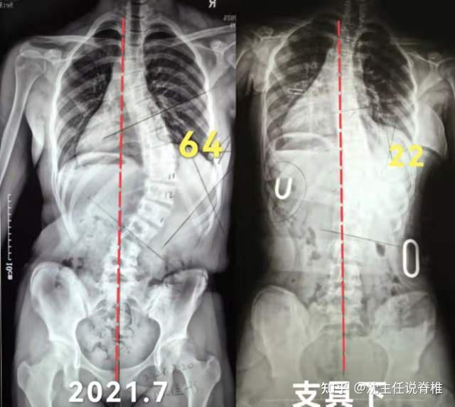 15岁女孩脊柱侧弯图片