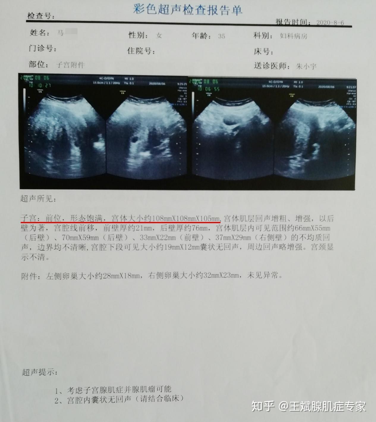 门诊日记腺肌症病痛八年差点切子宫的山西姐妹保宫手术7天后重生