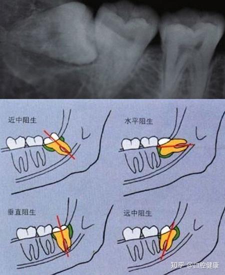 在這裡負責任的告訴大家,正規的口腔醫療機構都是不會亂收費的,拔智齒