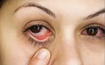 红眼病≠结膜炎,引起结膜炎的原因复杂,日常防范很关键。 - 知乎