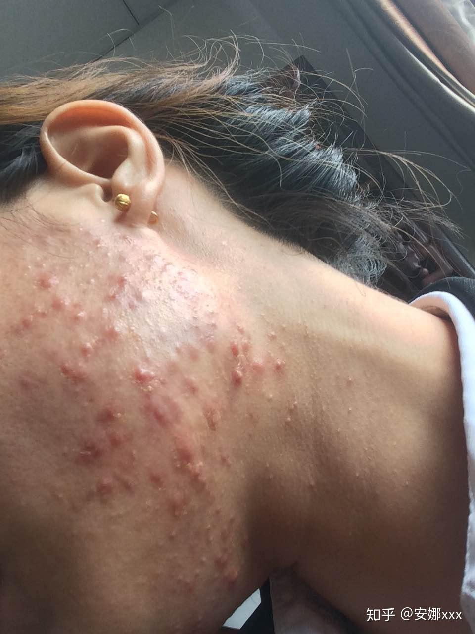 告别顽固痘痘我的祛痘经