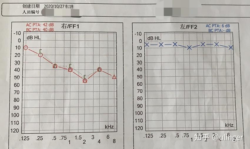 记录重度全频下降突发性耳聋治疗的全过程