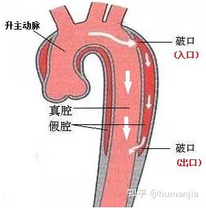 什么是动脉瘤会产生什么症状 v2-b1323d60c7c442a5524d8fd5c84935ca_b.jpg