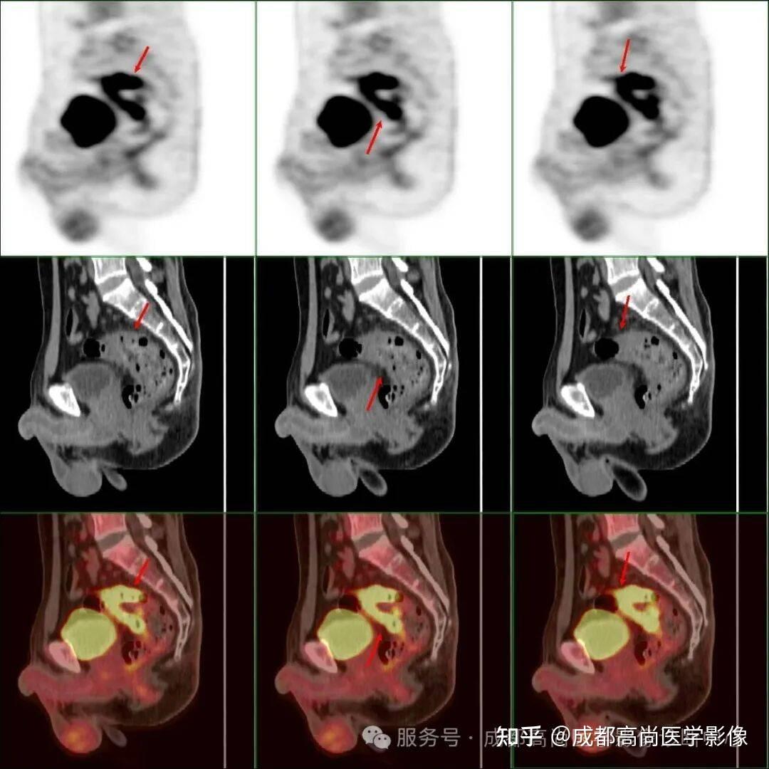 【高尚病例】47岁男大便不成形发现直肠腺癌,18F-FDG PET/CT联合HR-MR评估全身情况 - 知乎
