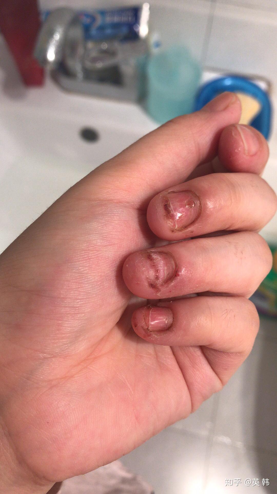 手指起小水泡好了又起脱皮又起怎么也治不好