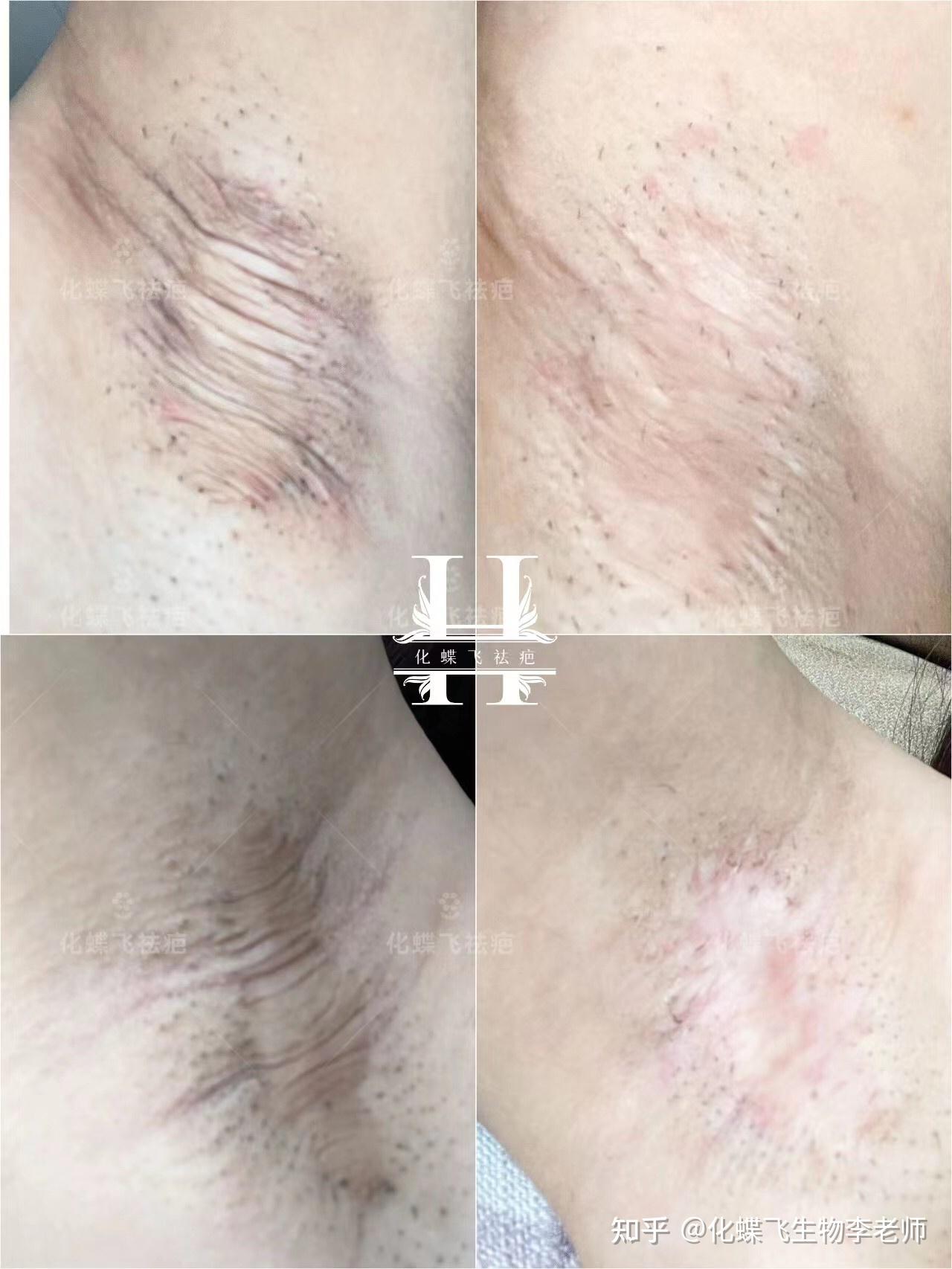 上海美女严重的腋下手术疤痕修复对比