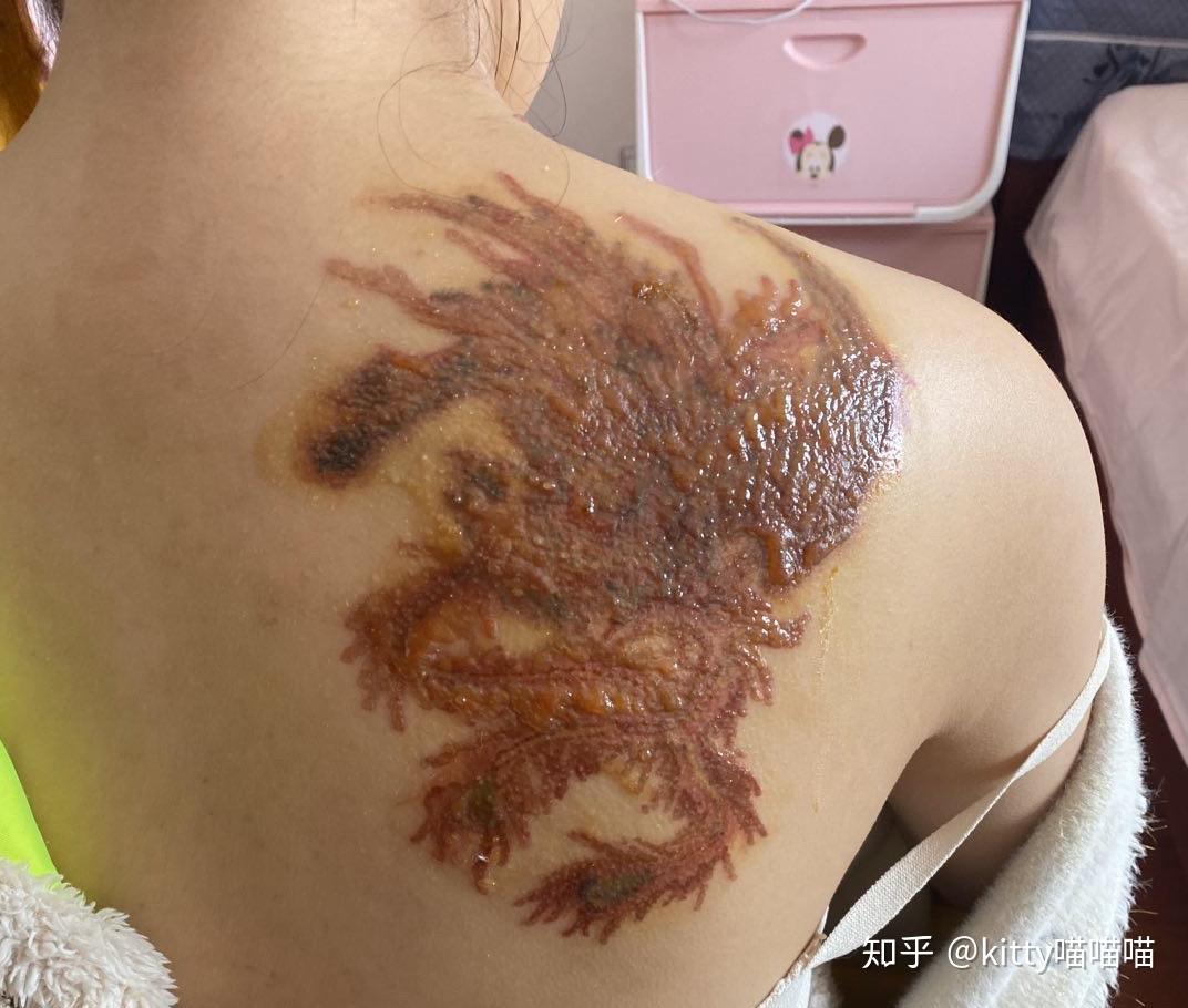 picoway超皮秒洗纹身/更新～应该是我最后一次登录知乎了 - 知乎