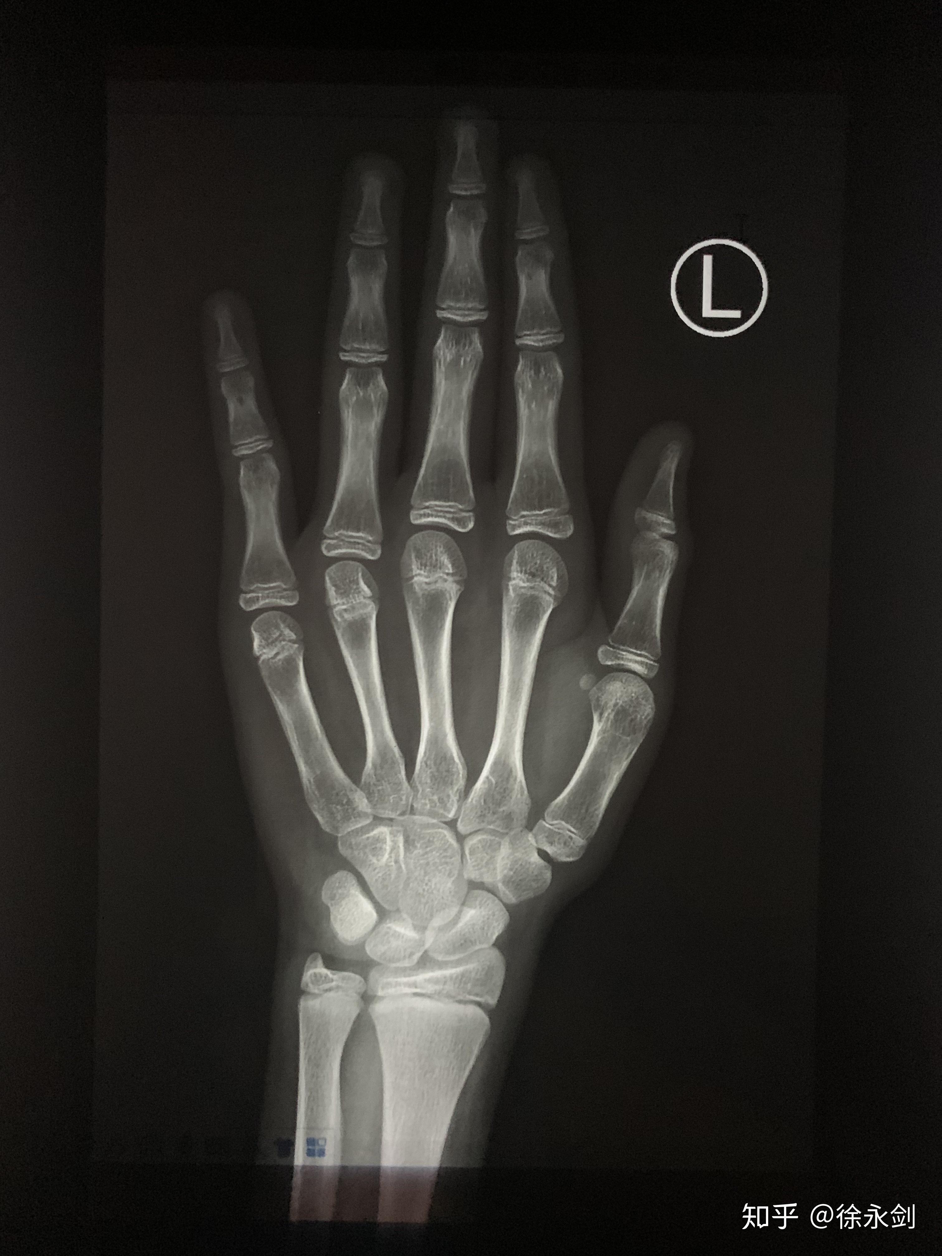 2岁骨龄,150.1基数预测未来身高158至164.中间值为161.