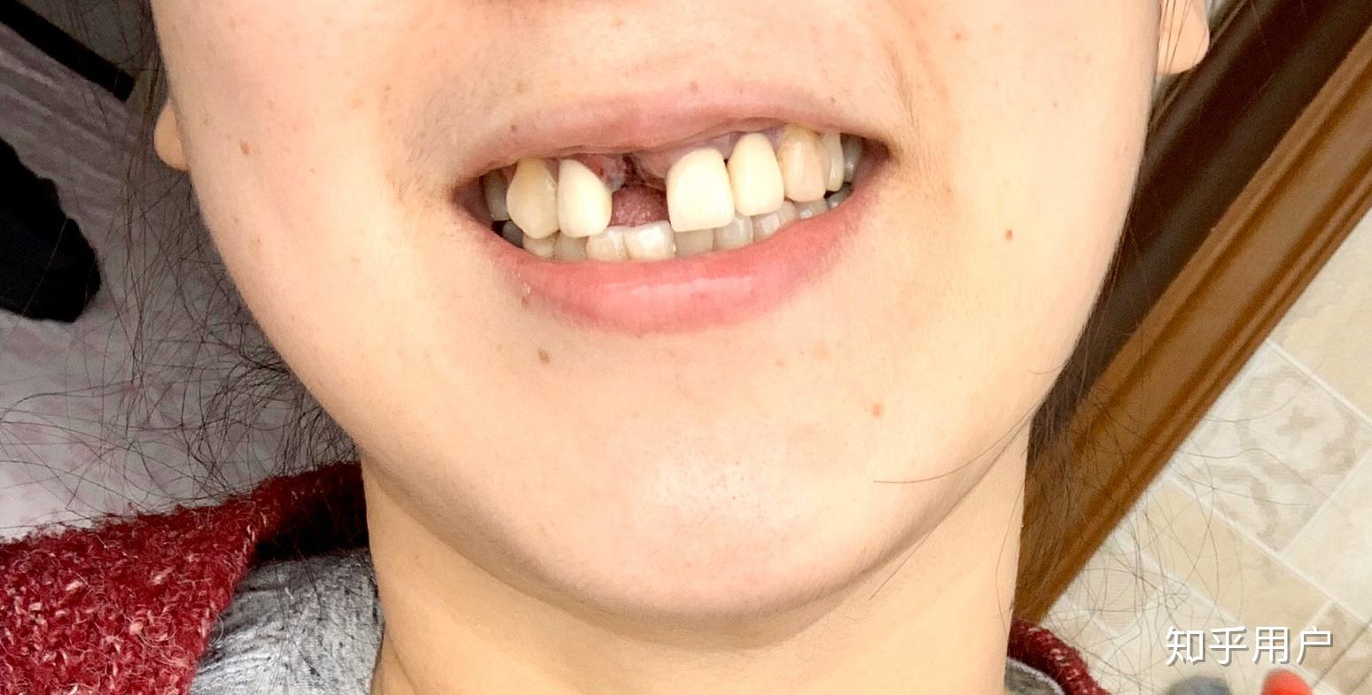 没有门牙是怎样的体验?