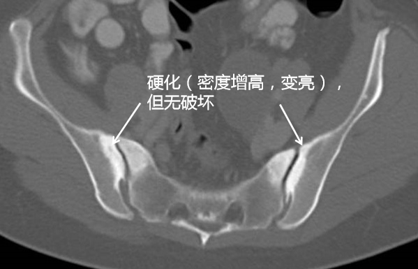 【致密性骨炎】虽然疼痛，不要害怕 - 知乎