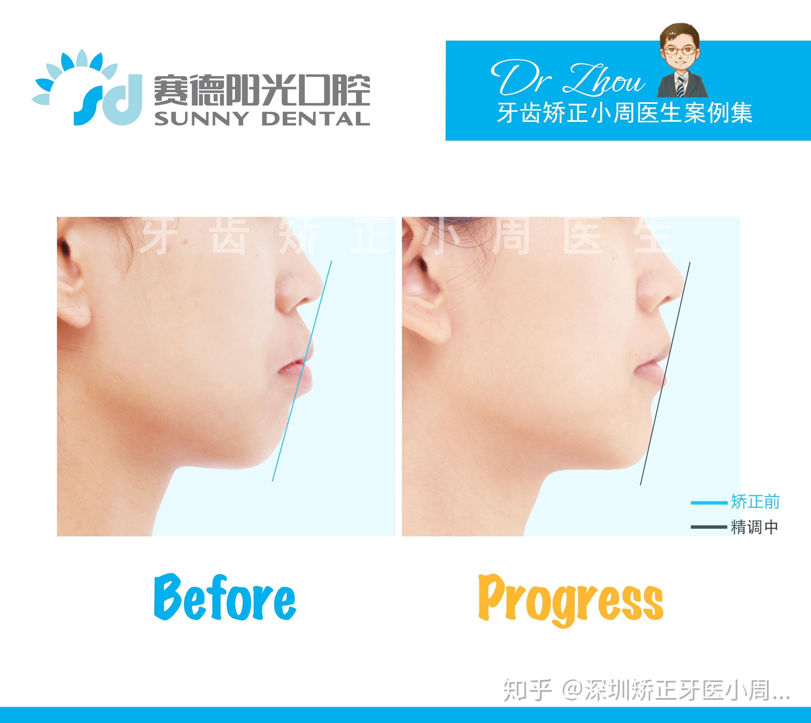 隐适美拔牙矫正上颌前突下颌后缩案例