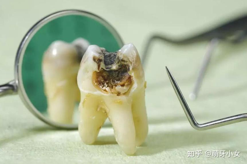 牙髓炎必须做根管治疗吗? - 知乎