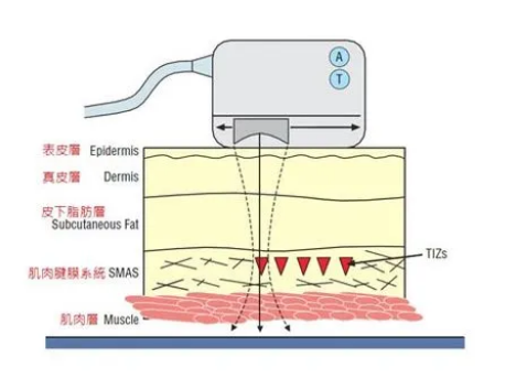 超声刀美容的功效和副作用 - 知乎