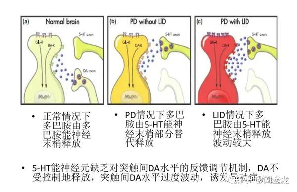 帕金森病脑深部电刺激术和异动症 - 知乎