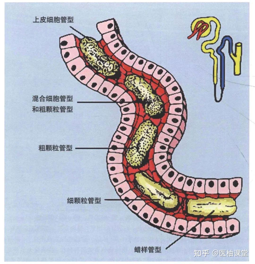 宽大管型图片