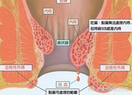 五一惠顾生孩子长了痔疮怎么办宝妈消痔的封信
