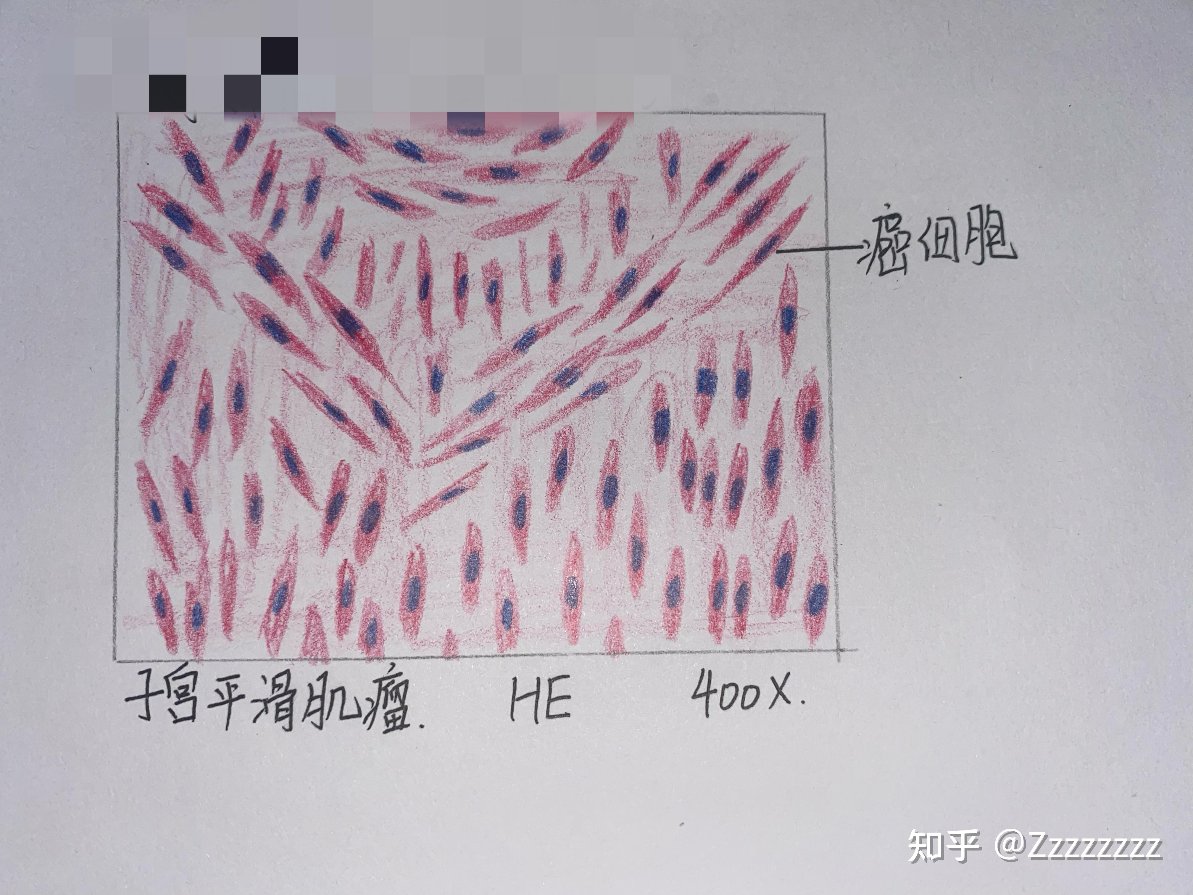 纤维肉瘤的红蓝铅笔图图片
