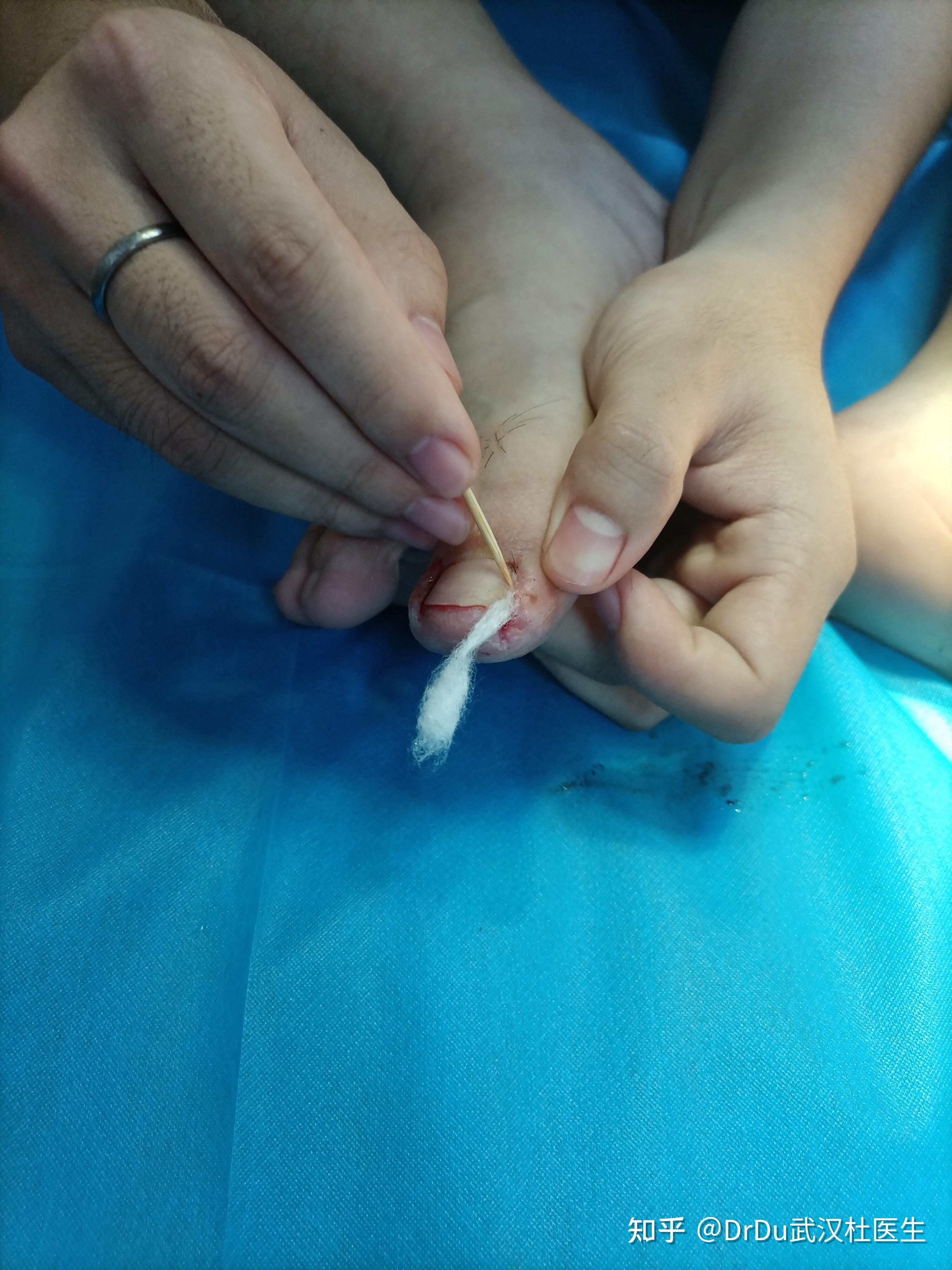 一例双足拇趾甲沟炎的手术病例