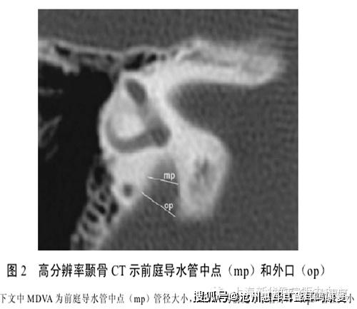 沧州惠耳教你读懂CT片——大前庭导水管综合征的CT影像学诊断 - 知乎
