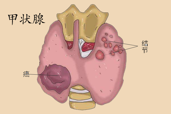 甲状腺癌为何女性患者多于男性
