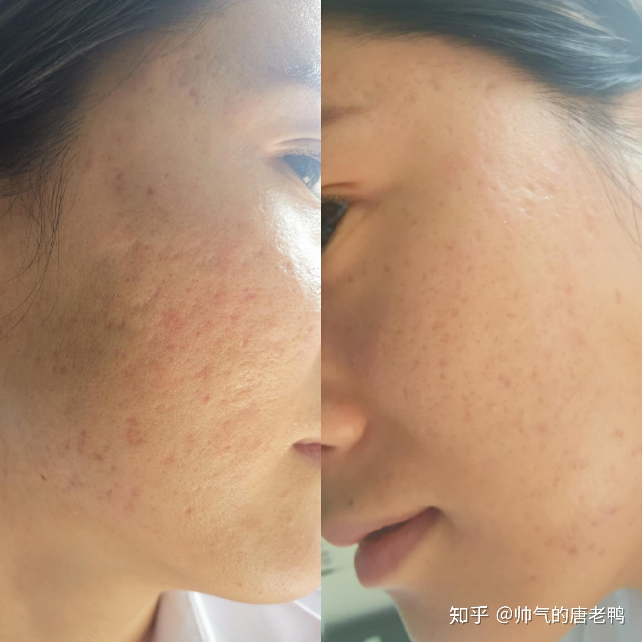 脂溢性皮炎痘痘肌康复过程