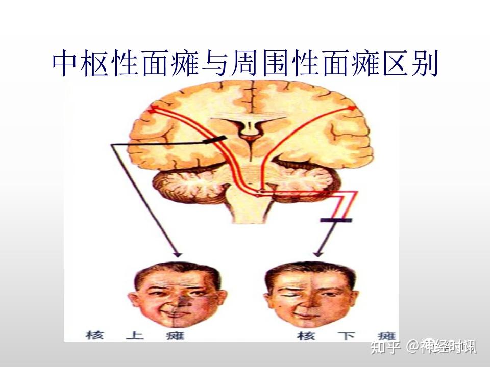 面神经解剖及相关病变 - 知乎