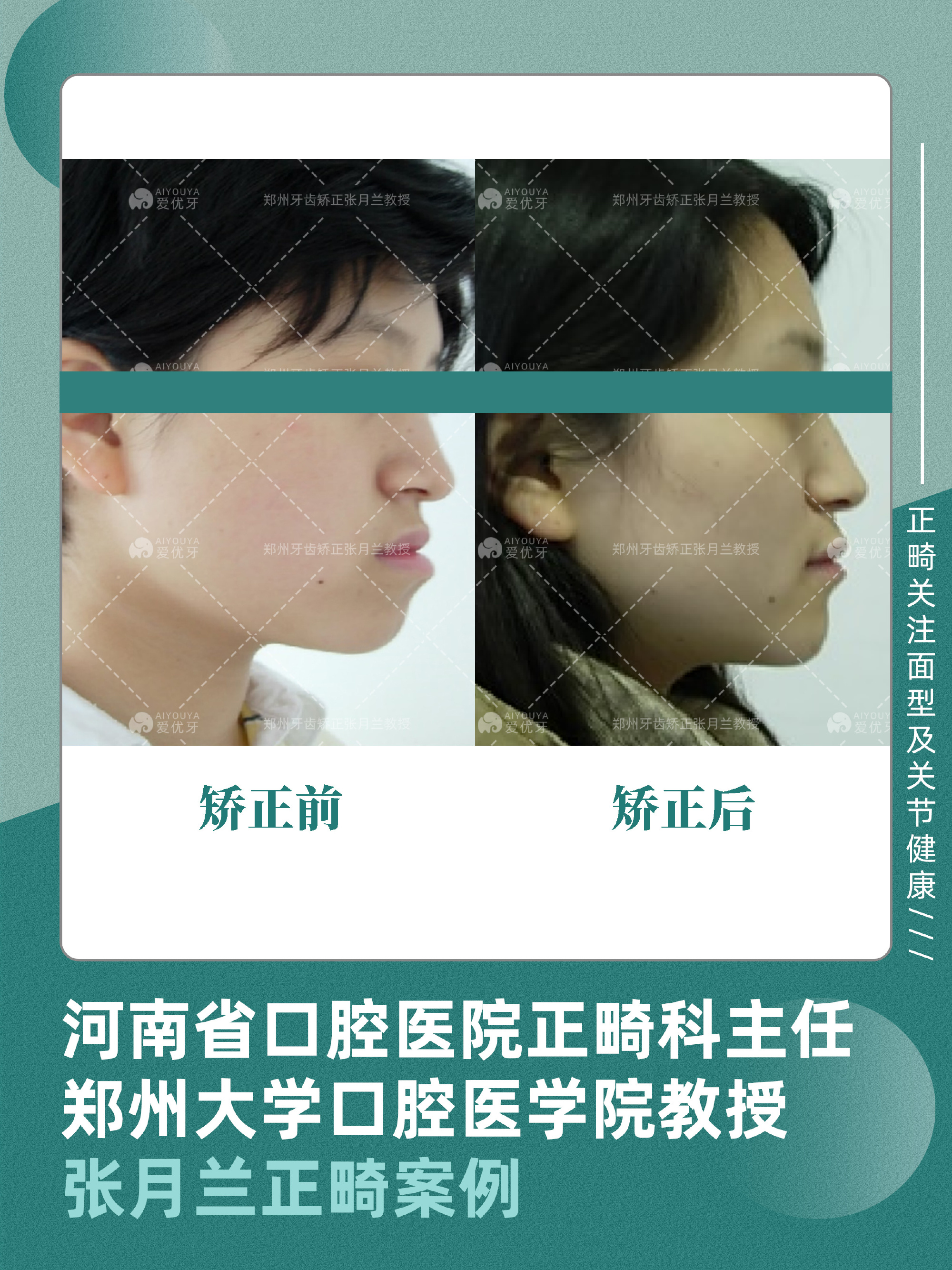高难度正畸案例|严重偏颌、反颌、下颌前突,单纯正畸解决颌平面偏斜 - 知乎