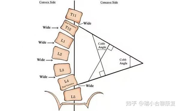 @家长:孩子高低肩体态不佳,脊柱侧弯可能是“背”后原因 - 知乎