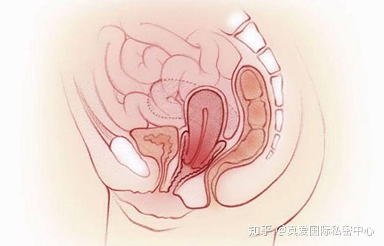 什麼是子宮下垂?