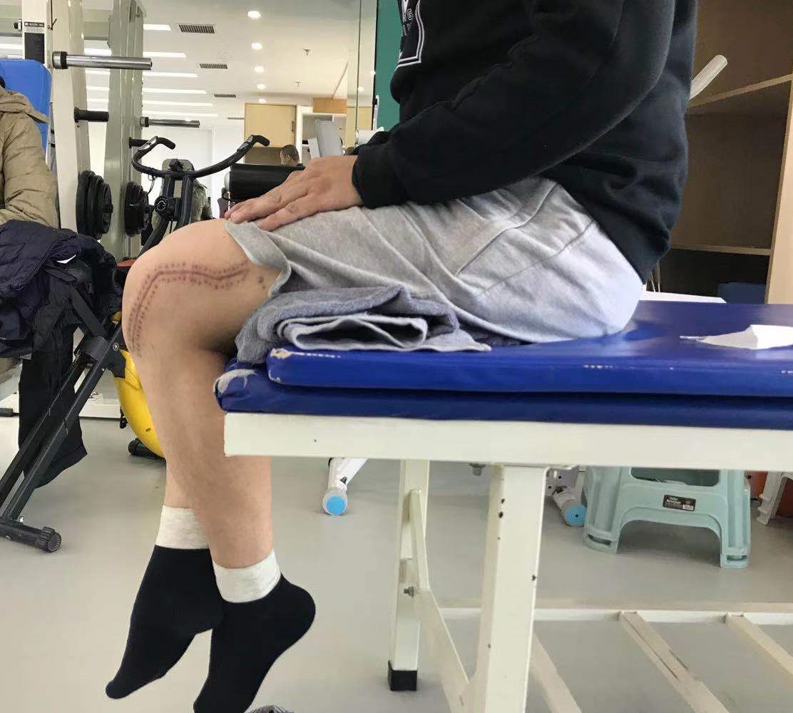 膝关节术后如何快速练习角度