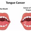 谈谈舌癌的预后和教训 知乎