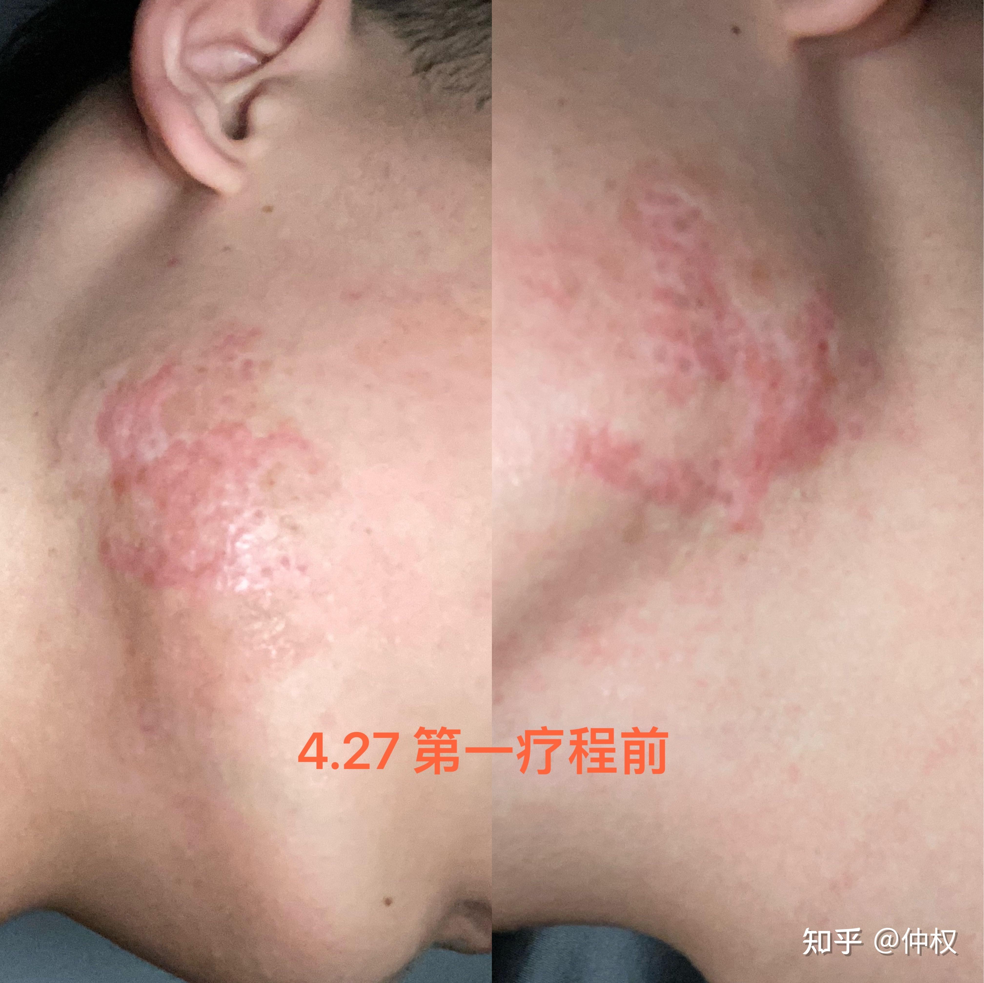 瘢痕疙瘩治疗 - 知乎