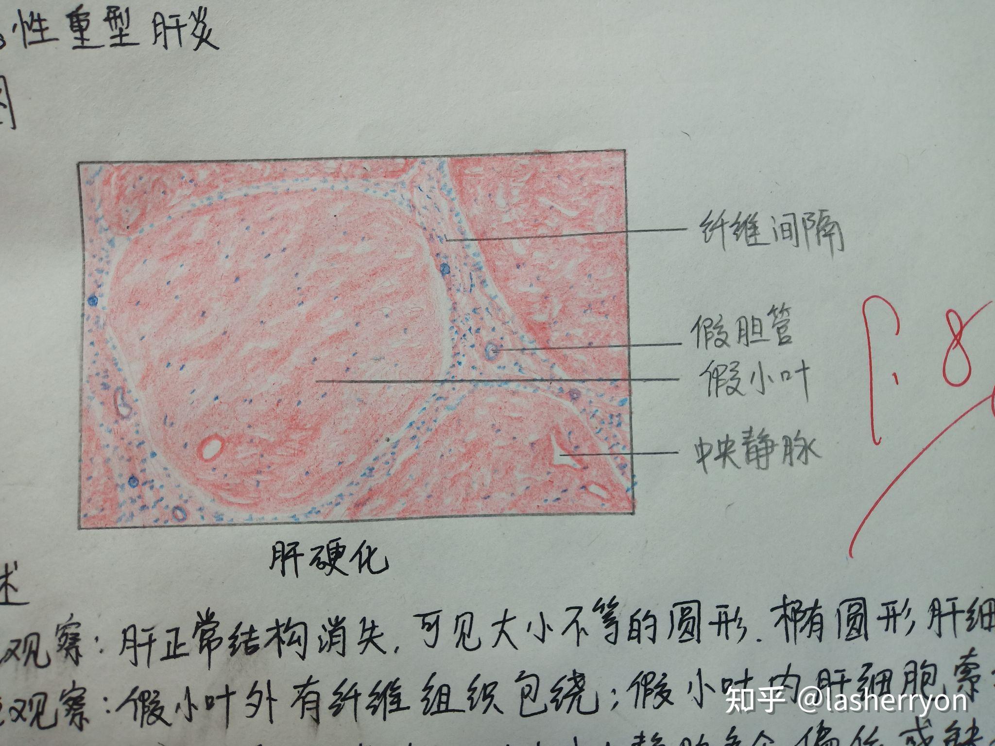 大叶性肺炎红肝期绘图图片